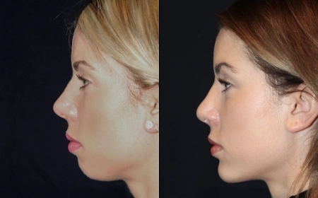 Best Doctors in dubai for Chin Fillers: How to Achieve a Natural Look
