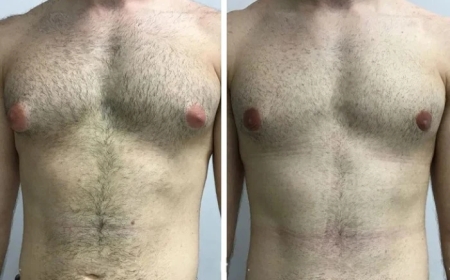 Risks and Benefits Explained by the Best Gynecomastia Surgeons in Dubai
