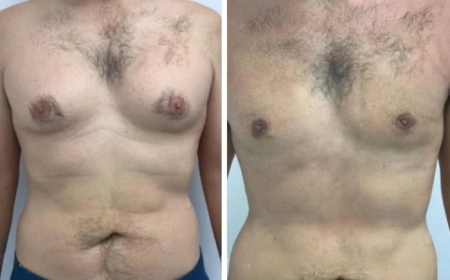 The Best Gynecomastia Surgeons in dubai: Your Guide to Recovery and Aftercare