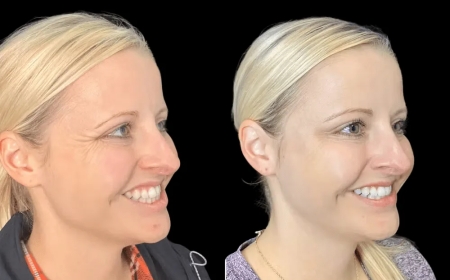 Smooth Smile Lines with Botox at the Best Aesthetic Clinic in dubai