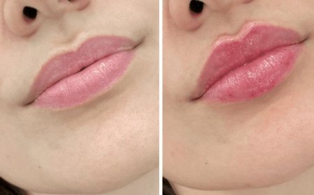Juvederm for Acne Scars: How the Best Plastic Surgeons in Dubai Use Fillers for Skin Rejuvenation