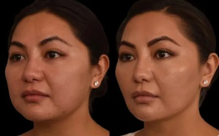 How Double Chin Removal Surgery Enhances Your Jawline: What You Need to Know from the Best Double Chin Removal Surgeon in Dubai