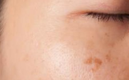 Understanding Actinic Keratosis Symptoms Treatment Options and Prevention Strategies for Sun Damaged Skin