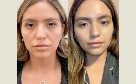 How the Best Plastic Surgeons in Dubai Achieve Natural Results with Thread Lift Procedures