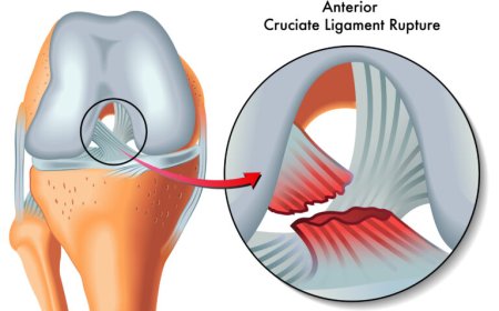 Emerging Dynamics and Growth Trajectory in Anterior Cruciate Ligament Injuries Market