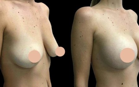The Cost of Quality: What You Pay for with the Best Breast Augmentation Surgeons in Dubai