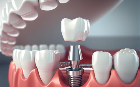 Why Dental Implants in Mumbai Are a Smart Choice