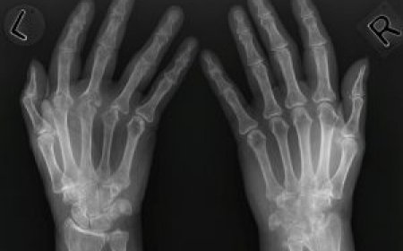 Erosive Hand Osteoarthritis Market Size, Trends, and Growth Outlook 2025-2032