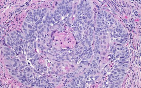 Advanced Non-Squamous and Squamous NSCLC Market: Growth, Challenges, and Strategic Outlook