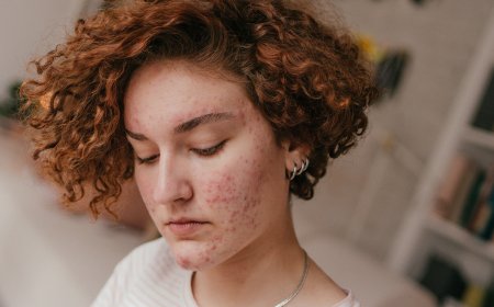 Crestal Acne Treatment: Gentle on Skin, Tough on Pimples